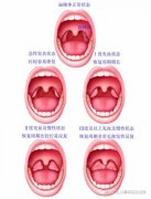 孩子感冒怎么总和扁桃体有关？扁桃体发炎还有