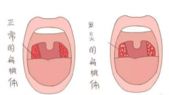 重庆仁品耳鼻喉医院_导致扁桃体炎的因素