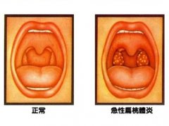 重庆仁品耳鼻喉医院_扁桃体炎的危害