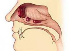 重庆仁品耳鼻喉医院_鼻息肉的症状