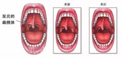 扁桃体炎反复发作怎么办?-重庆好的耳鼻喉医院