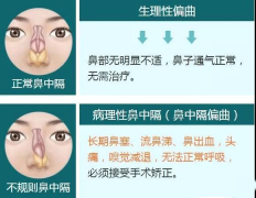 重庆耳鼻喉科医院-鼻中隔偏曲做手术有后遗症吗？