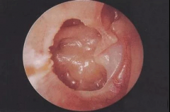 导致分泌性中耳炎的因素-重庆好的耳鼻喉医院