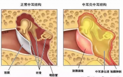 【科普】中耳炎不可怕，治疗不及时才可怕