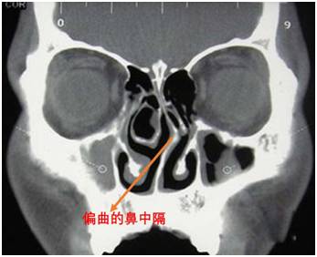 鼻中隔偏曲
