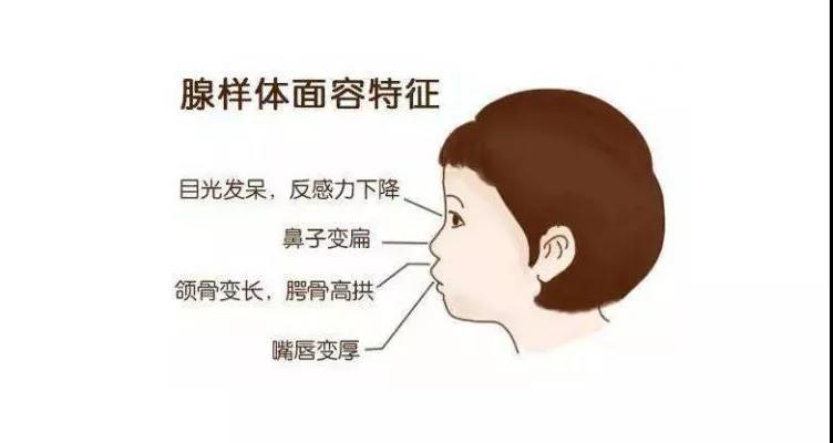 腺样体肥大