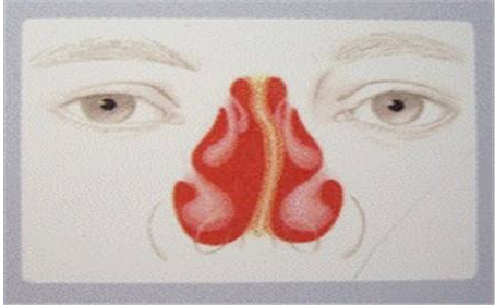 鼻中隔偏曲的危害有哪些