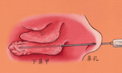 哪些因素导致的鼻甲肥大-重庆耳鼻喉医院