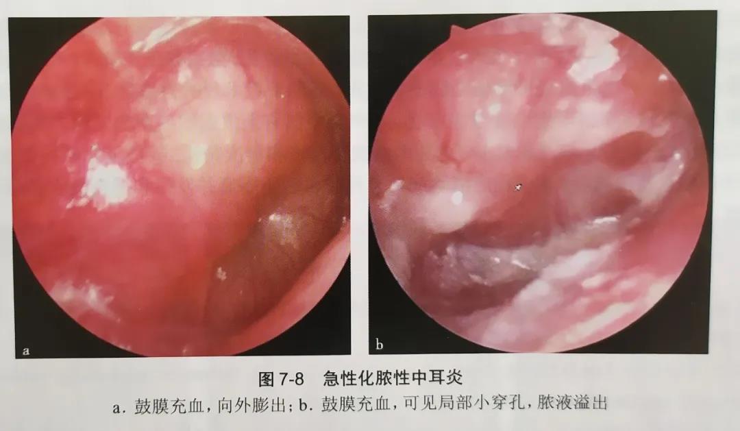 急性化脓性中耳炎