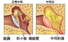 重庆中耳炎的危害有哪些
