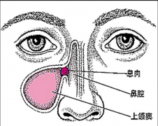 鼻息肉常见的症状表现有哪些呢