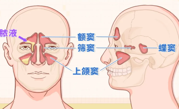 鼻窦炎