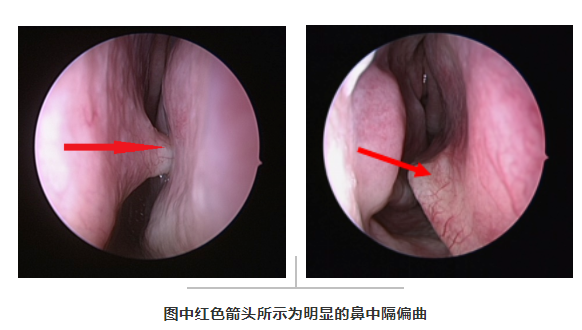 鼻中隔偏曲