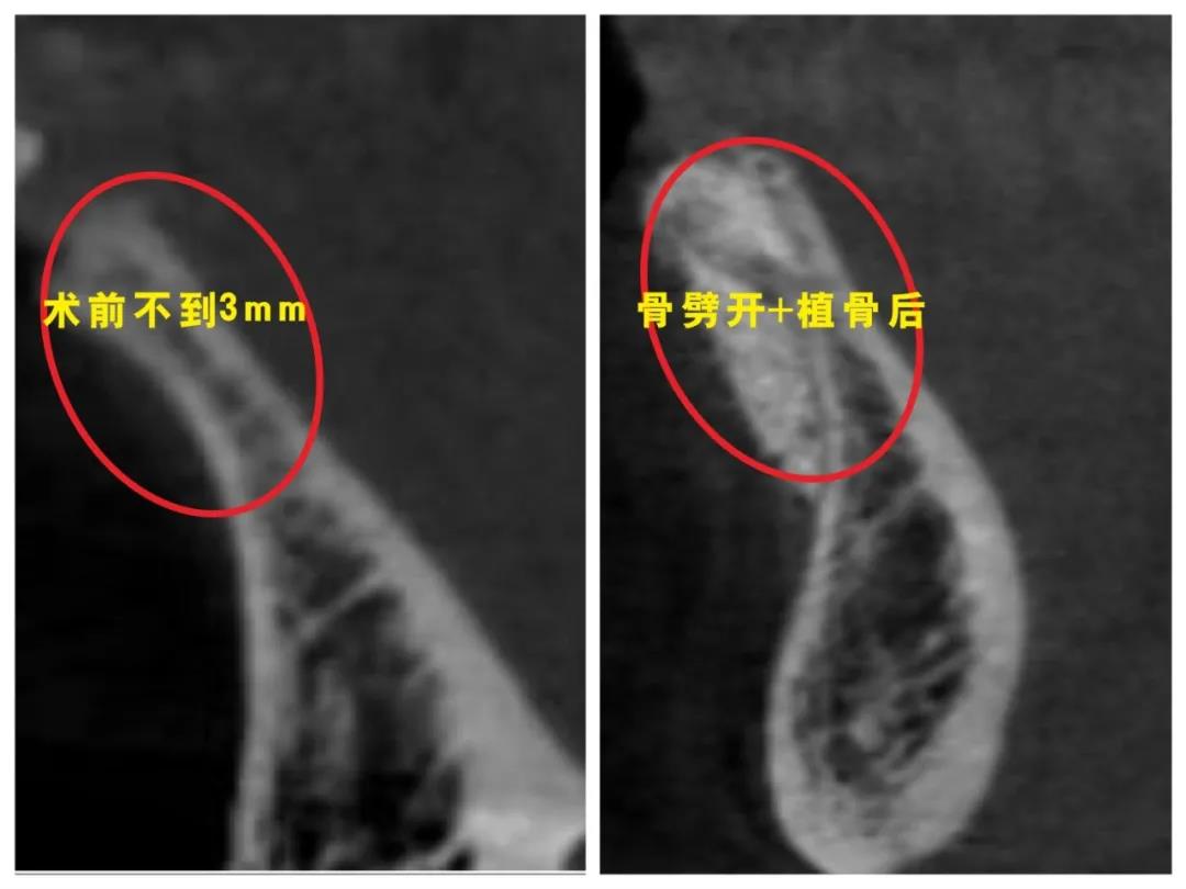 口腔CT结果