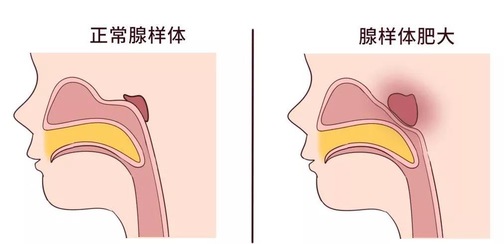 腺样体肥大