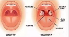 扁桃体炎的危害有哪些？重庆耳鼻喉医院哪家好