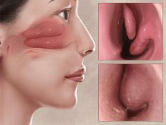 预防慢性鼻炎的发生，冬季需做好哪些预防工作？