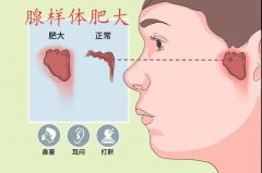 腺样体肥大几岁做手术为最佳年龄?腺样体肥大的原因是什么？