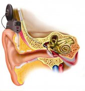 你是否听说过人工耳蜗植入？