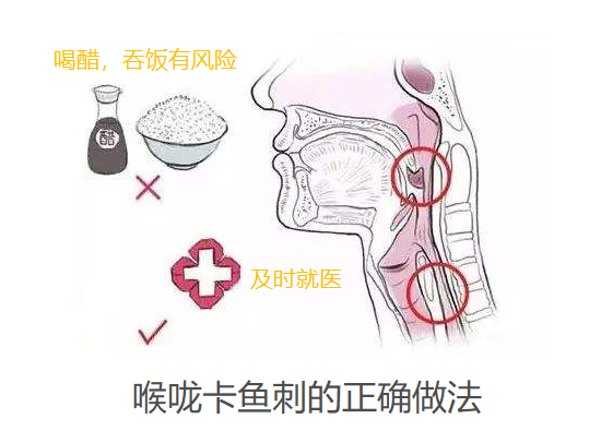 卡鱼刺