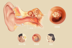 外耳道胆脂瘤的临床表现
