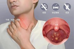 重庆慢性咽炎医院，慢性咽炎的常见病因