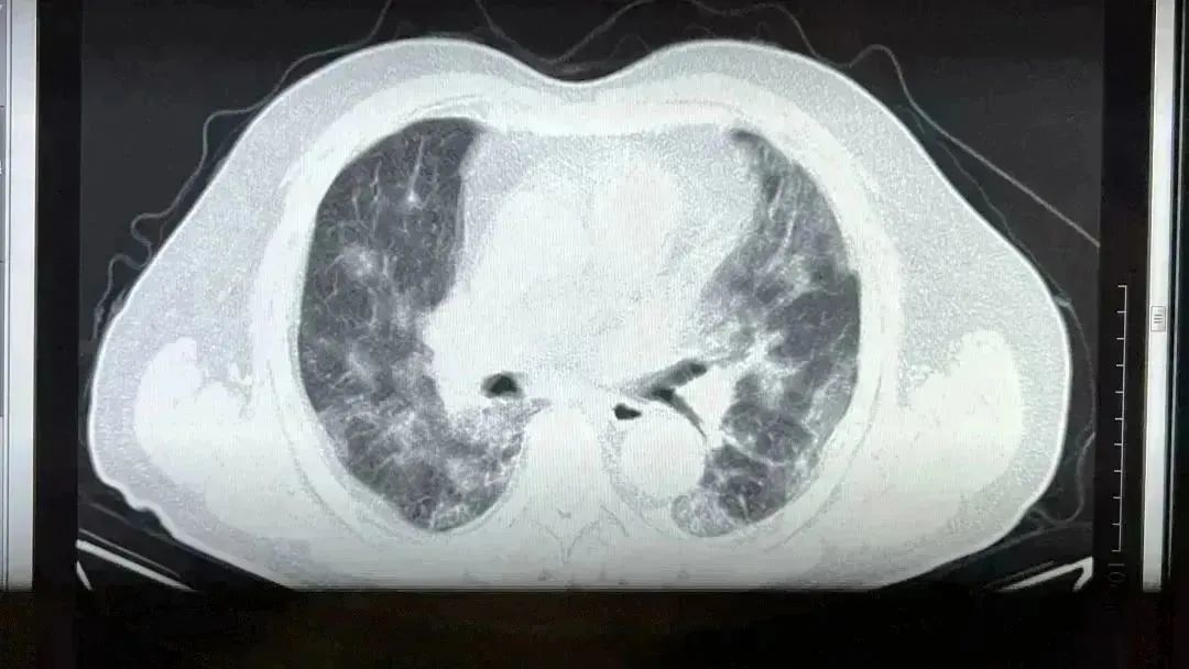 肺部感染
