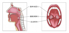 急 孩子腺样体肥大，一定要做手术吗？