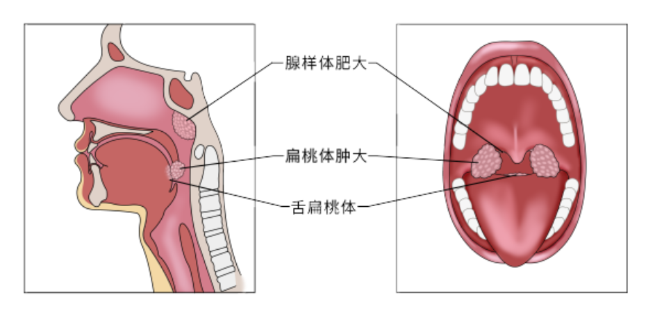 腺样体肥大