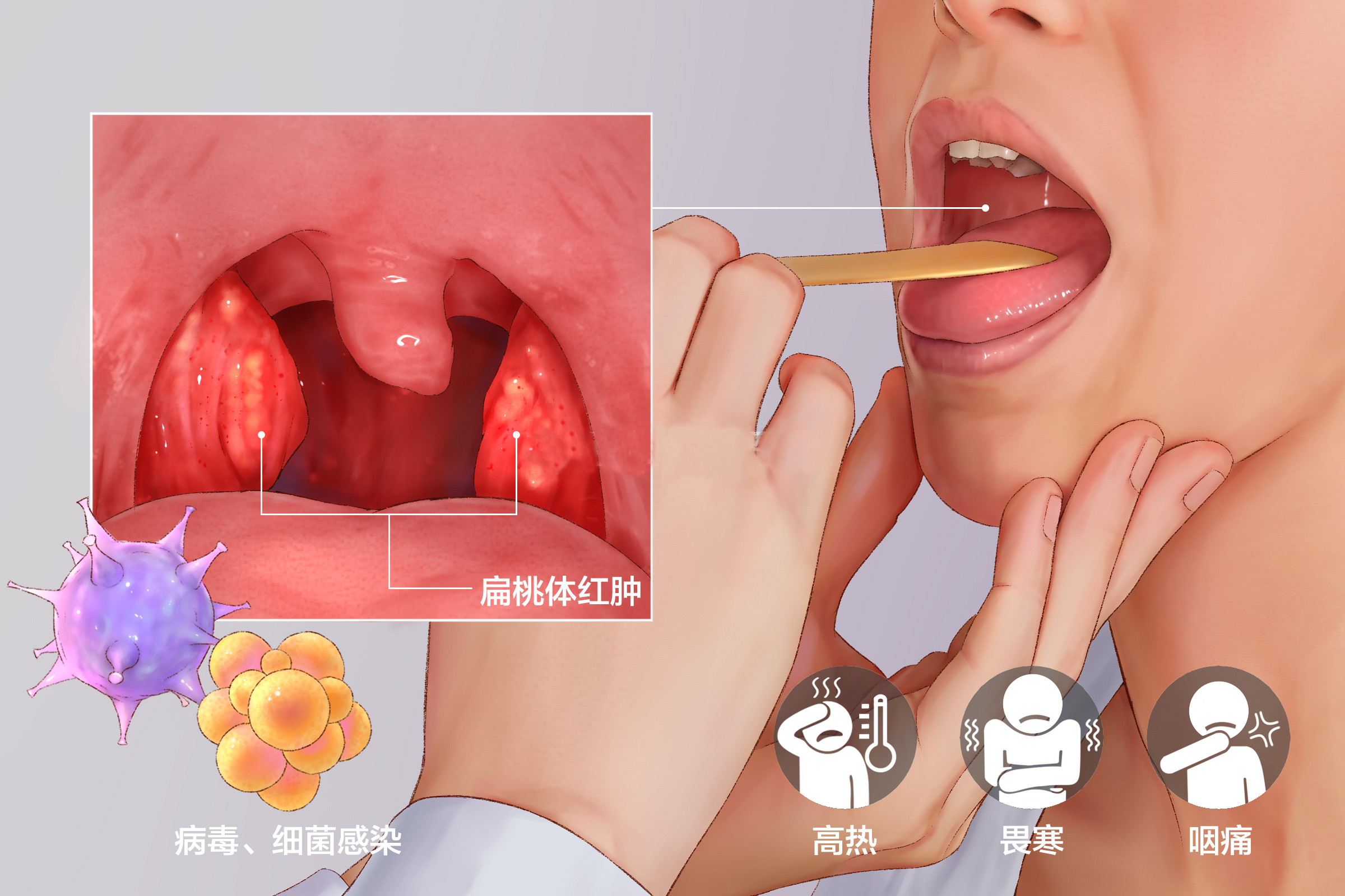 重庆扁桃体炎医院