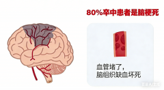 1分钟搞清楚：卒中、中风、脑梗、脑溢血，关键时能救命